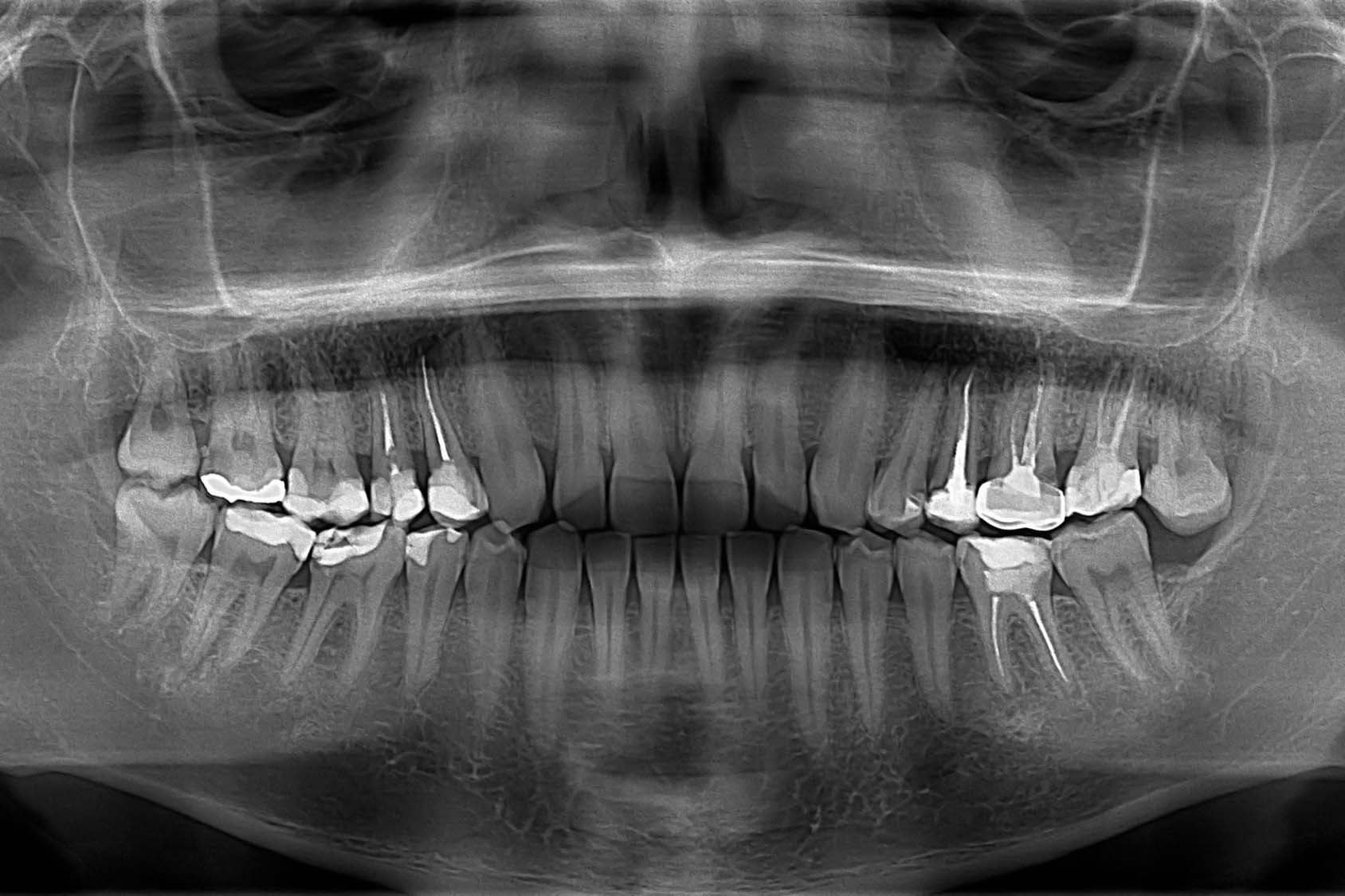 Использование ортопантомограммы в качестве панорамного снимка зубов